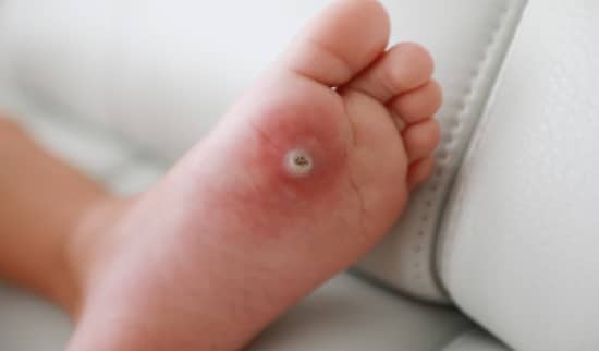 bradavice na stopalih