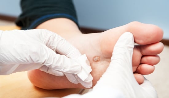 odpravimo bradavice na stopalih