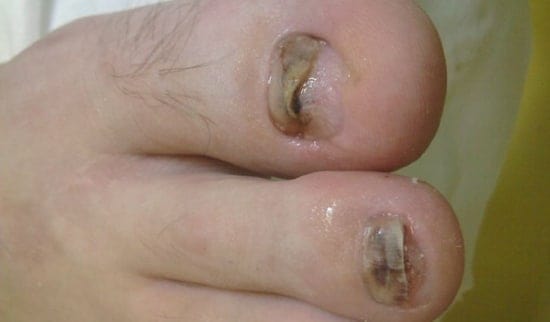 fotodinamicna terapija in glivični nohti