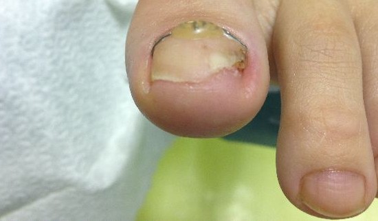 Primer glivičnih nohtov 1