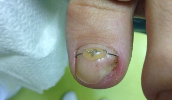 Primer glivičnih nohtov 9