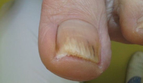 Primer glivičnih nohtov 7