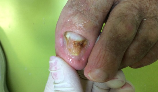 Primer glivičnih nohtov 6