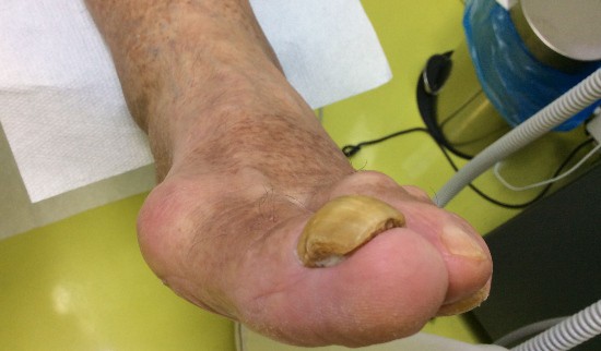 Primer glivičnih nohtov 5