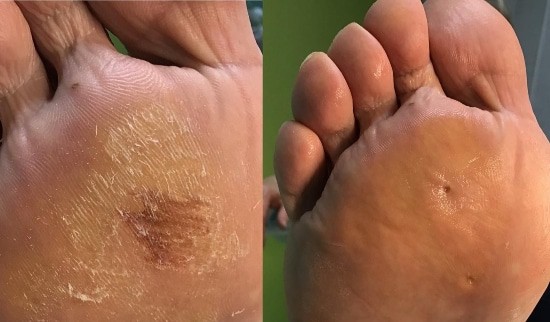 Kurja očesa uspešno saniramo v Pedimedu