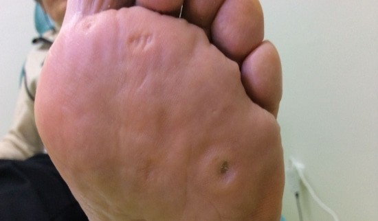 Kurja očesa uspešno saniramo