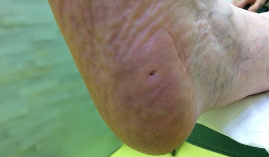 Sanacija kurjega očesa