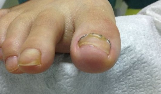 Primer glivičnih nohtov 4