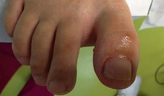 Primer glivičnih nohtov 3