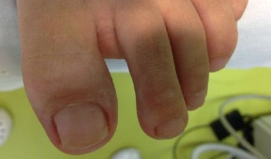 Primer glivičnih nohtov 2