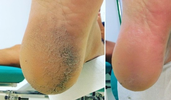 trda koža na podplatih