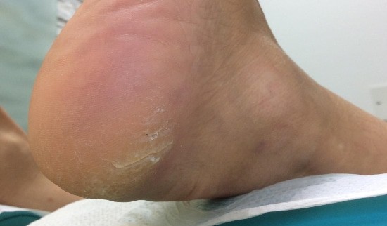 trda koža na podplatih