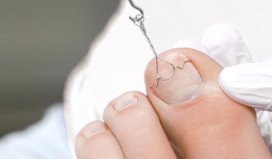 Medicinska Pedikura vraščeni nohti Aleja