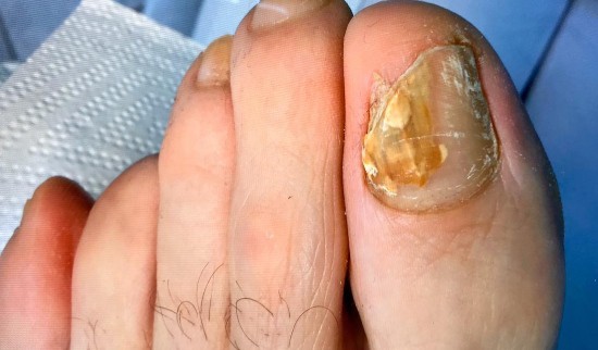 glivice na nohtih prej potem pedimed