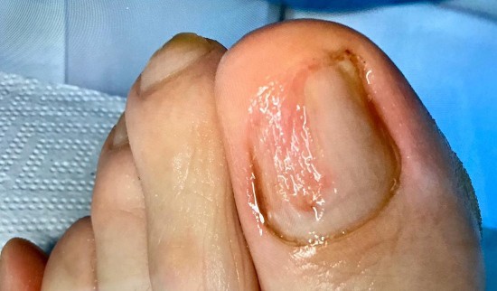 glivice na nohtih prej potem pedimed