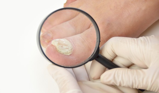 glivice na nohtih saniramo