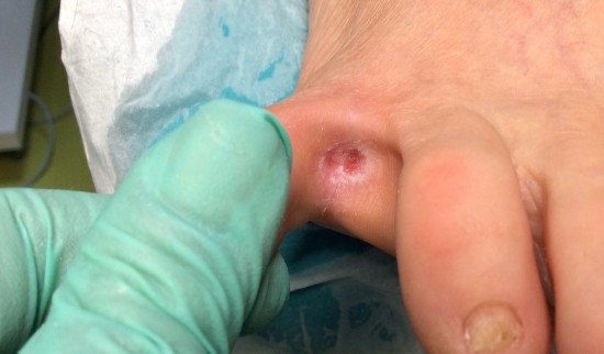 Sanacija kurjega očesa