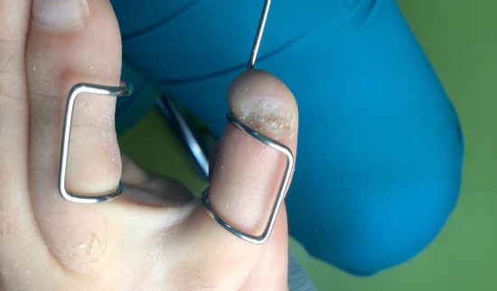 Sanacija kurjega očesa