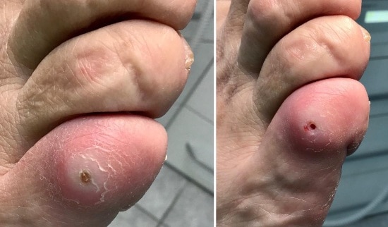 Sanacija kurjega očesa