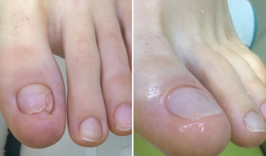 pedimed nohtna protetika