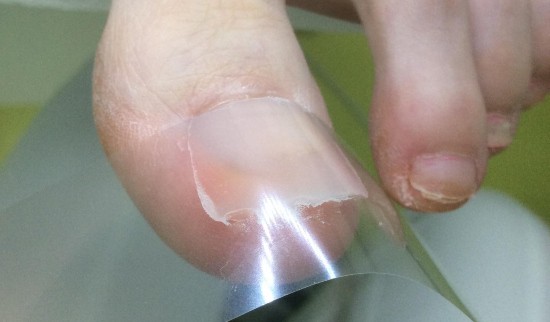 nohtna protetika prej potem