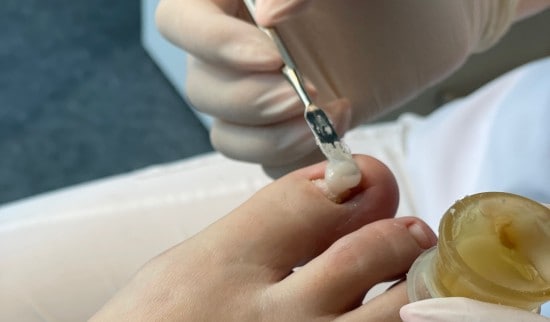 proces nohtne protetika - 1