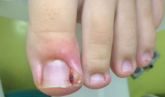 težave z vraščenimi nohti